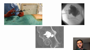 Imagerie interventionnelle - consolidation et ablathermie