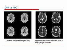 Traitement d'images médicales avancé : IRM de diffusion