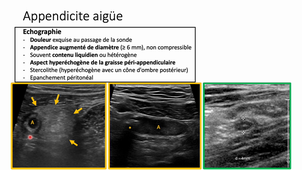 Imagerie abdomen pelvis - Douleurs FID