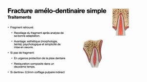 Traumatologie alvéole-dentaire-Les fractures