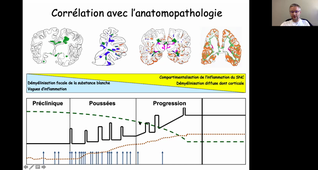 Sclérose en plaques