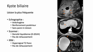 Imagerie abdomen pelvis - Nodule hépatique