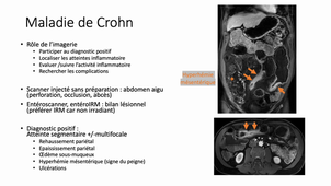 Imagerie abdomen pelvis - Maladie inflammatoire de l'intestin