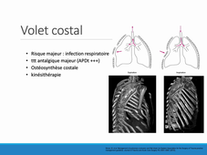 Traumatisme thoracique (Heger)