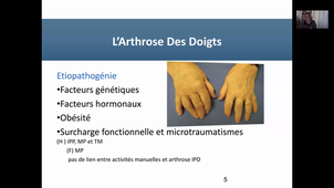arthrose des doigts